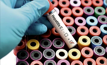  Hepatit C-elimineringsarbetet i Sverige – Hur går det?